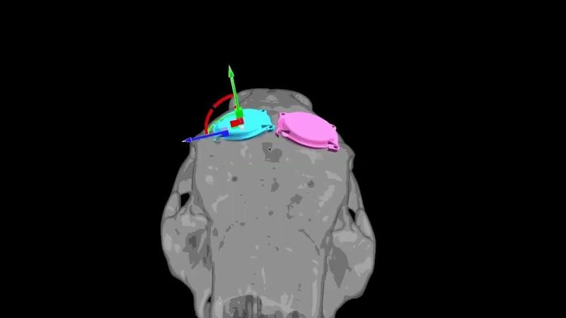 Имплантация нейрочипа Neuralink: новые достижения и планы на будущее