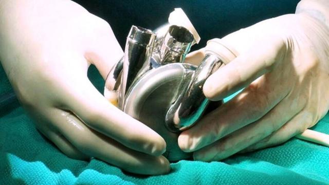 Искусственное титановое сердце: будущее медицины